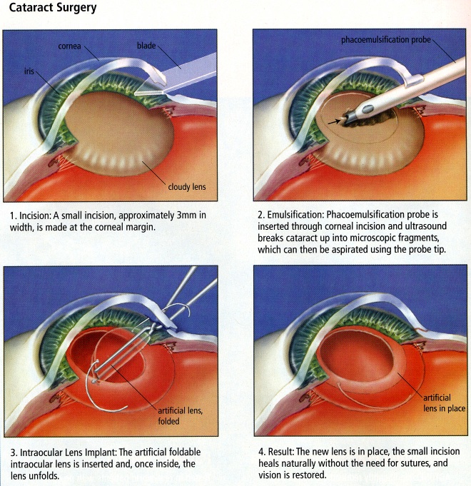 Cataract-Surgery