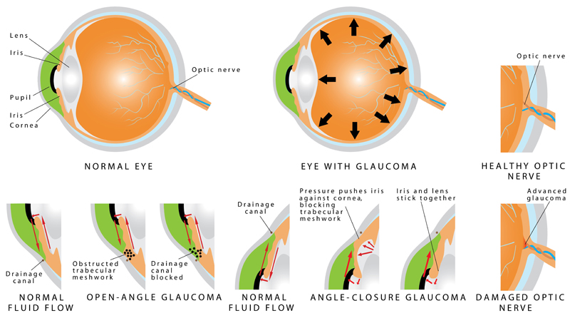 GlaucomaTreatment