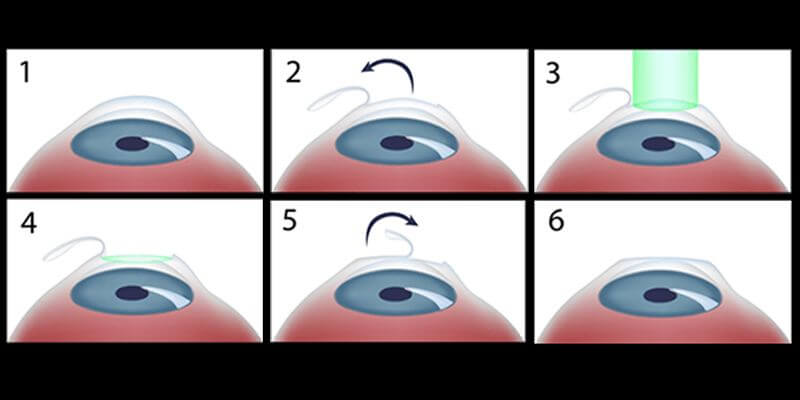 LASIK-Surgery