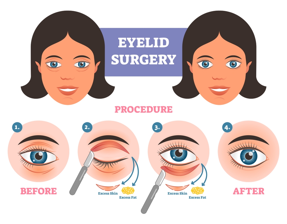 OculoplastyTreatment