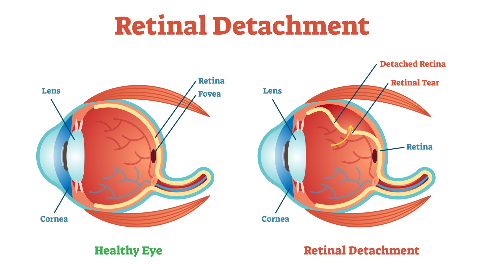 RetinaDisorders