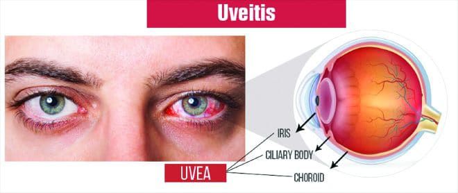 Uveitis